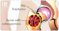 Osteoporosis can cause fractures