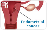 Understanding Progesterone Replacement Therapy