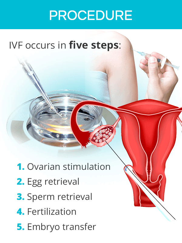 IVF Procedure