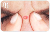 Natural Remedies for Hormonal Acne