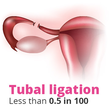 Chances of pregnancy after tubal ligation