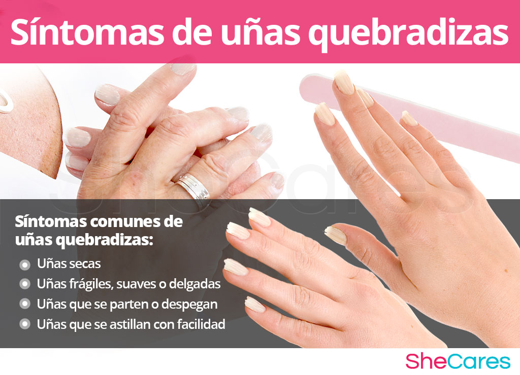 Síntomas de uñas quebradizas