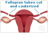 Fallopian tubes cut and cauterized