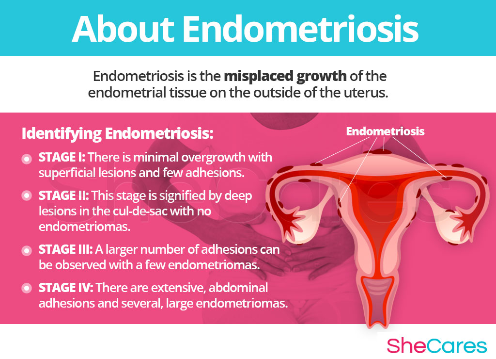 Especialistas endometriosis barcelona
