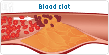 Blood clot