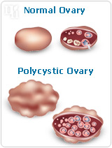 Normal ovary and polycystic ovary