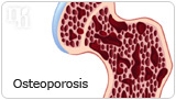 Osteoporosis