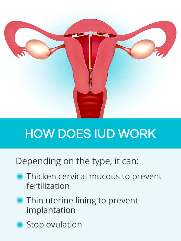 How does iud work