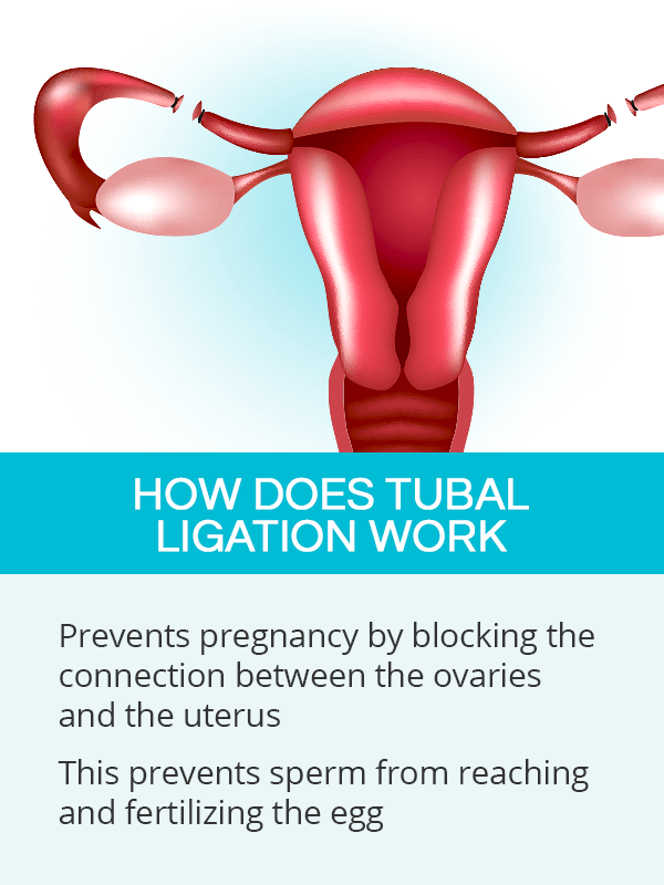 How does tubal ligation work