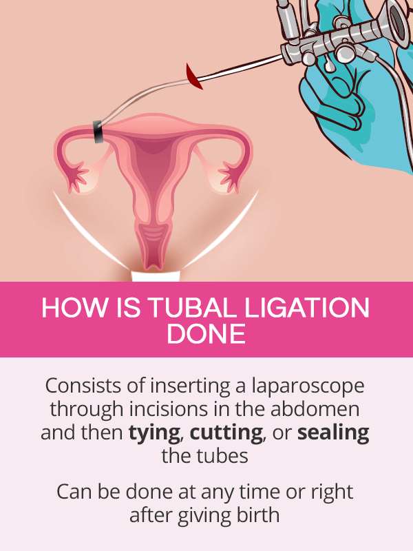 How is tubal ligation done