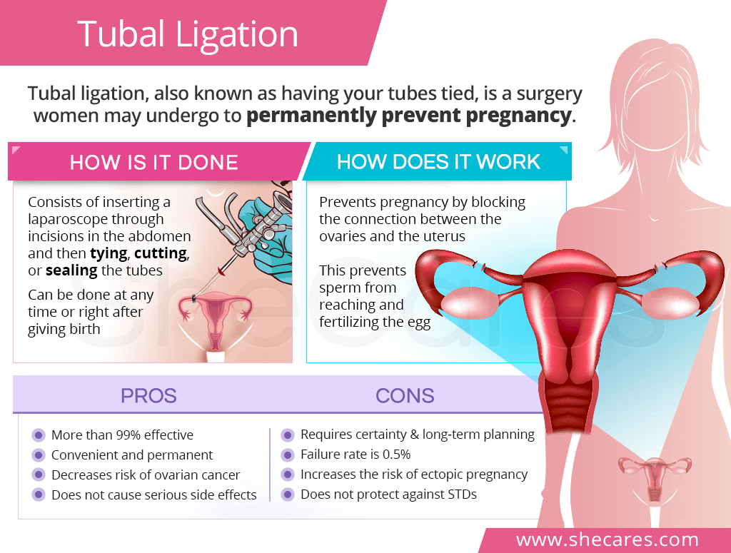 Tubal ligation