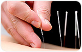 Acupuncture Accepted as Reliable Treatment for Migraines