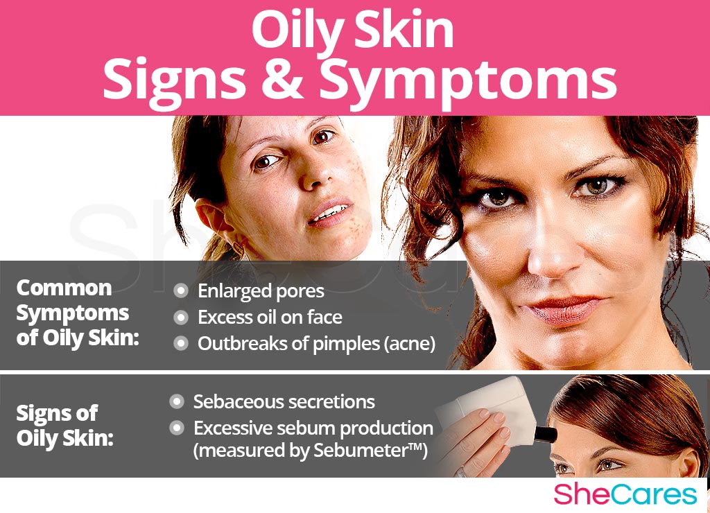 Oily Skin - Signs and Symptoms