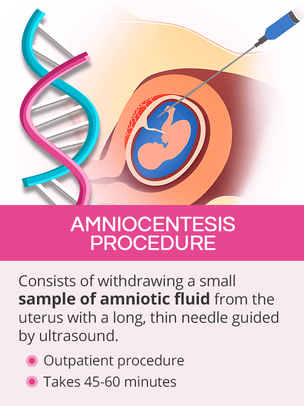 Amniocentesis procedure