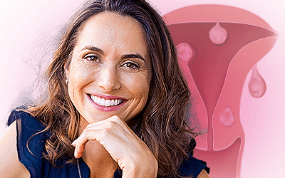 Uterine Fibroids after Menopause
