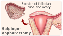 estrogen optorectomy