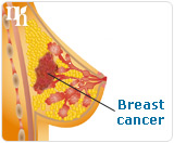 Breast cancer