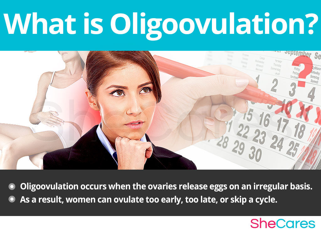 What is oligoovulation