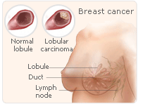 HRT carcinoma