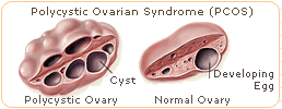 polycystic ovarian syndrome pcos