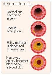 Hrt arteroescelosis