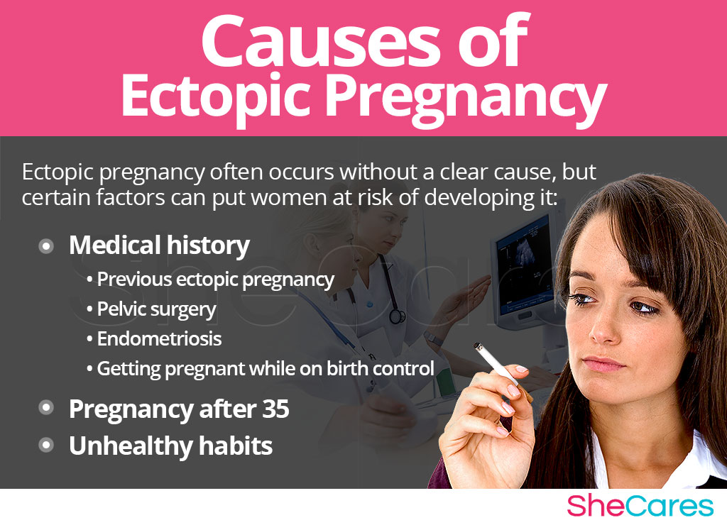 Causes of Ectopic Pregnancy