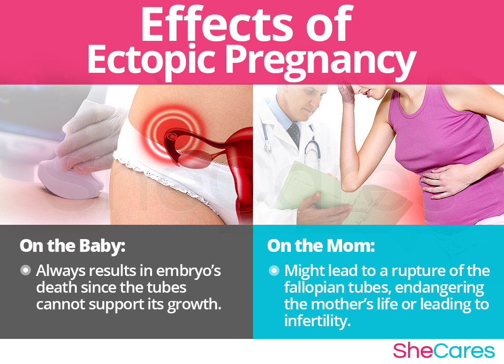 Effects of Ectopic Pregnancy