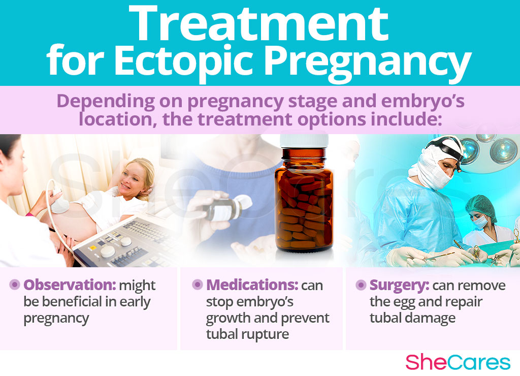 Treatment for Ectopic Pregnancy