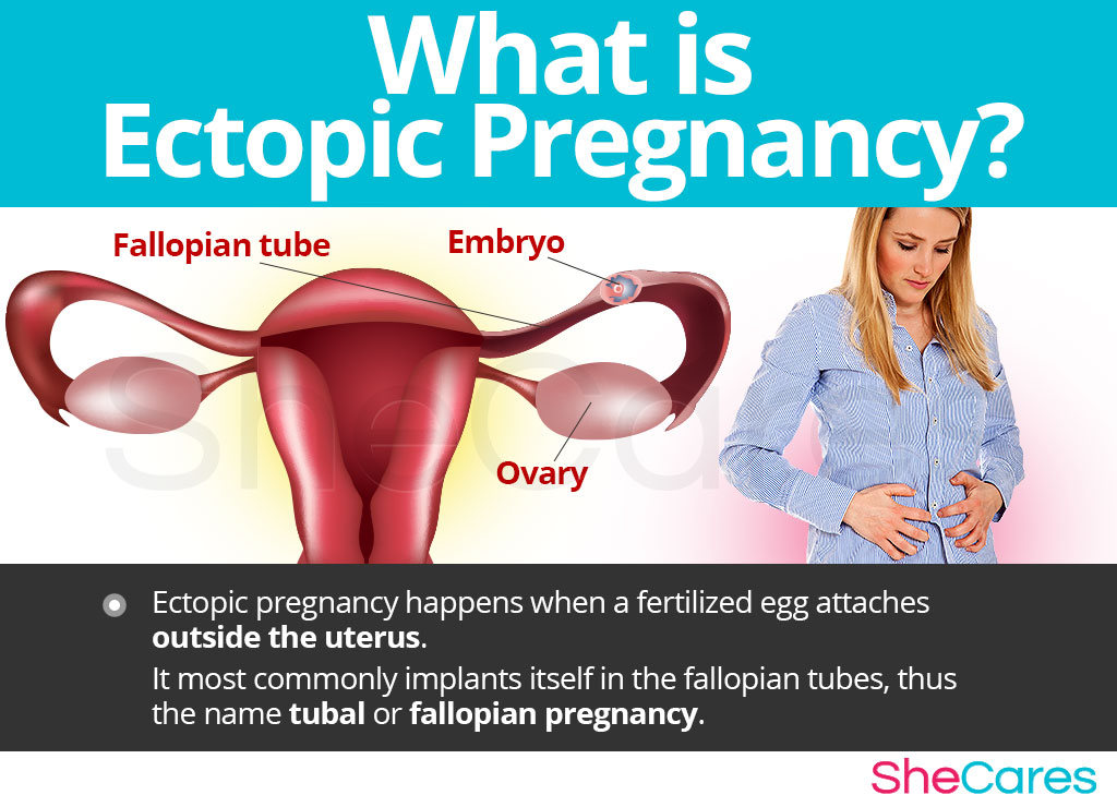 What is Ectopic Pregnancy?