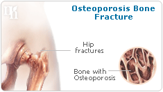 estrogen fractures