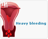 Heavy bleeding