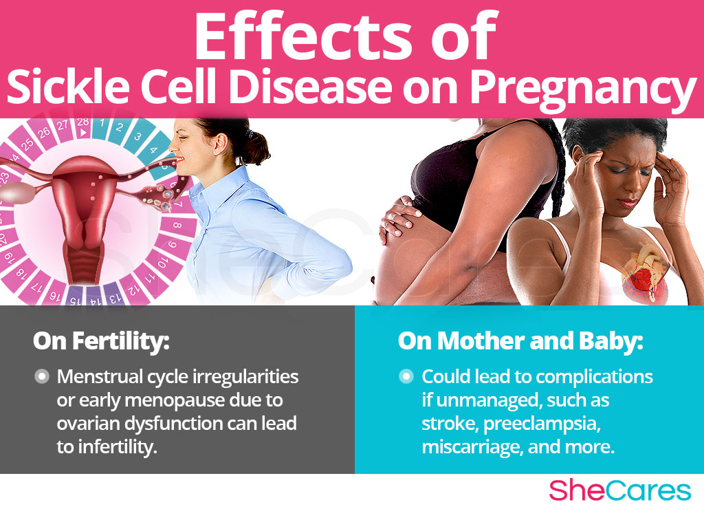 Effects of Sickle Cell Disease on Conception