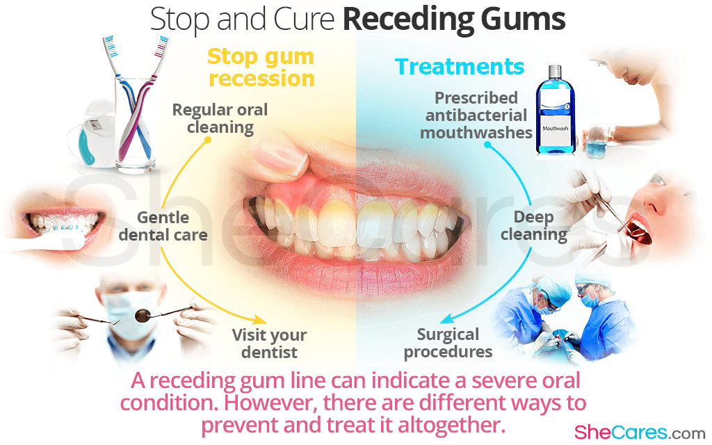 A receding gum line can indicate a severe oral condition. However, there are different ways to prevent and treat it altogether.