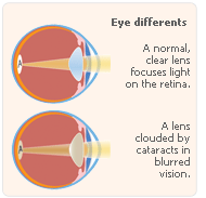 estrogen cataratcs