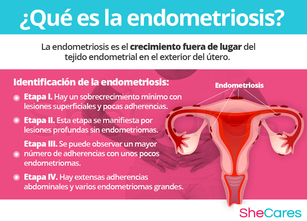 ¿Qué es la endometriosis?