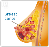 Using HRT for osteoporosis can cause breast cancer and troubles with blood clots