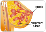 Breast cancer could be one of the serious consequences of estrogen dominance