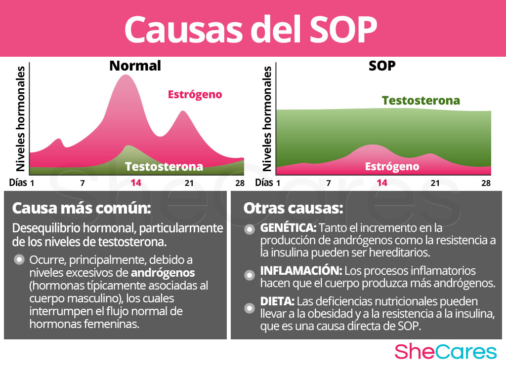 Causas del SOP