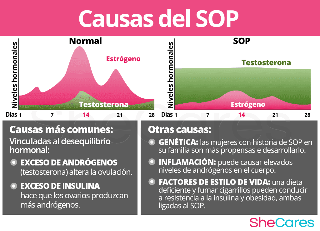 Causas del SOP