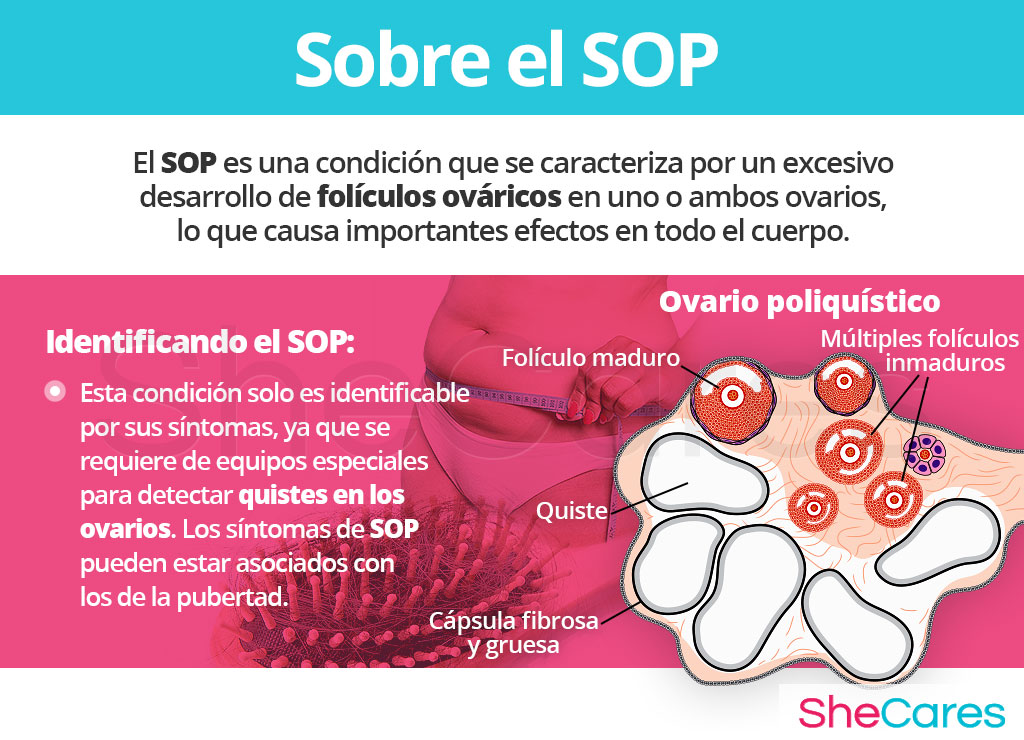 Acerca del síndrome de ovario poliquístico SOP