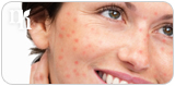 Testosterone therapy can result in side effects such as acne