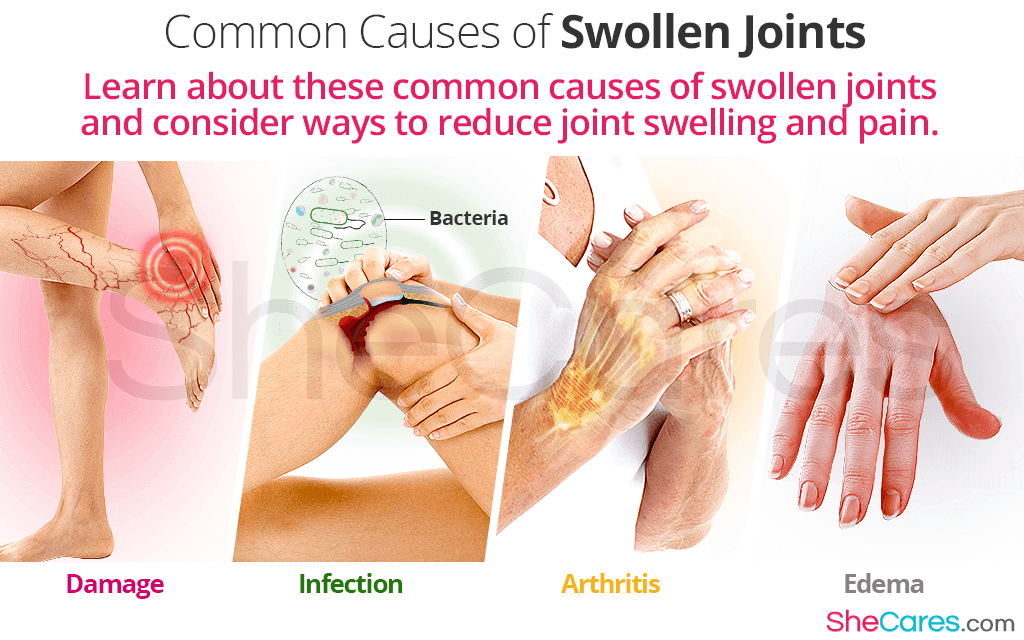 Common Causes of Swollen Joints