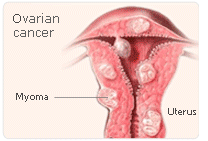 HRT cancer risk